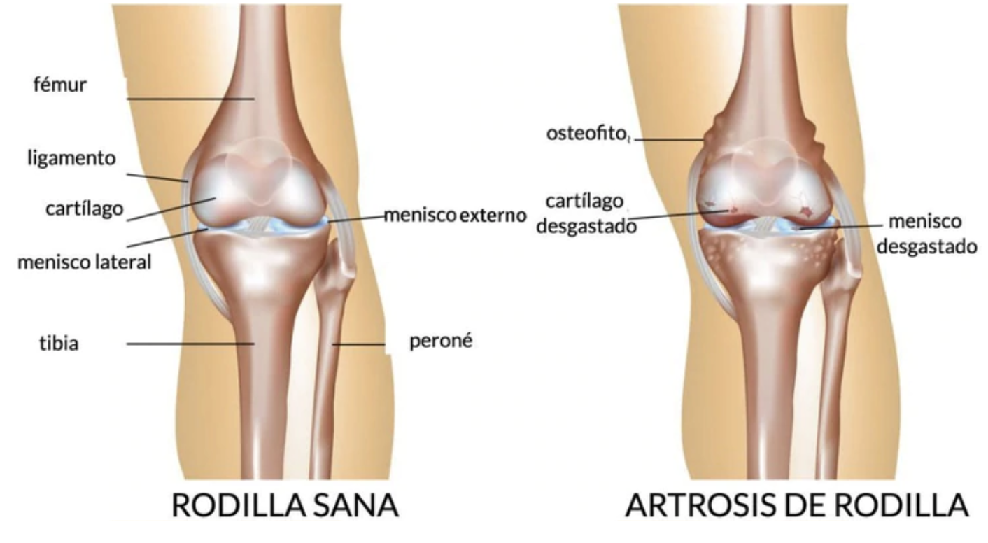 Artrosis de Rodilla