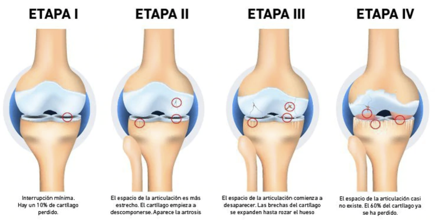 Artrosis de Rodilla